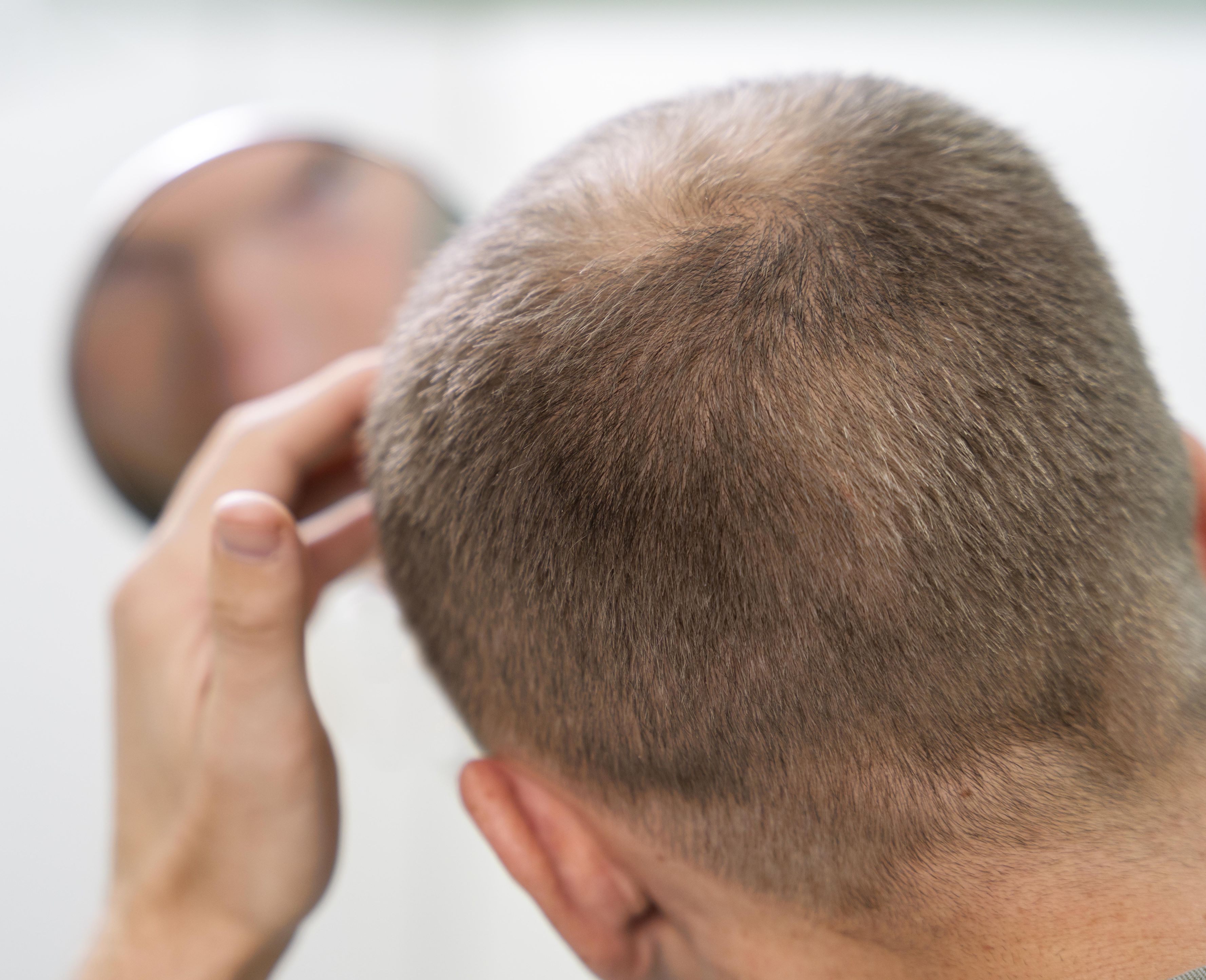 Understanding the Direct Hair Implantation (DHI) Technique for Hair Restoration