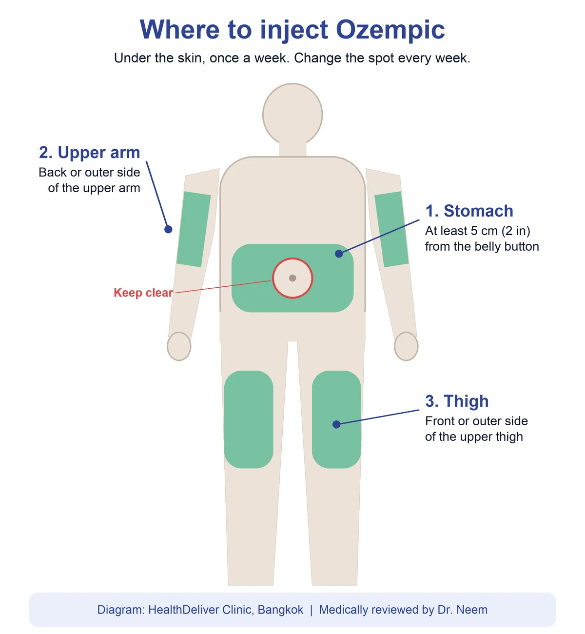 Diagram of where to inject Ozempic: stomach at least 5 cm (2 inches) from the belly button, back or outer upper arm, and front or outer upper thigh